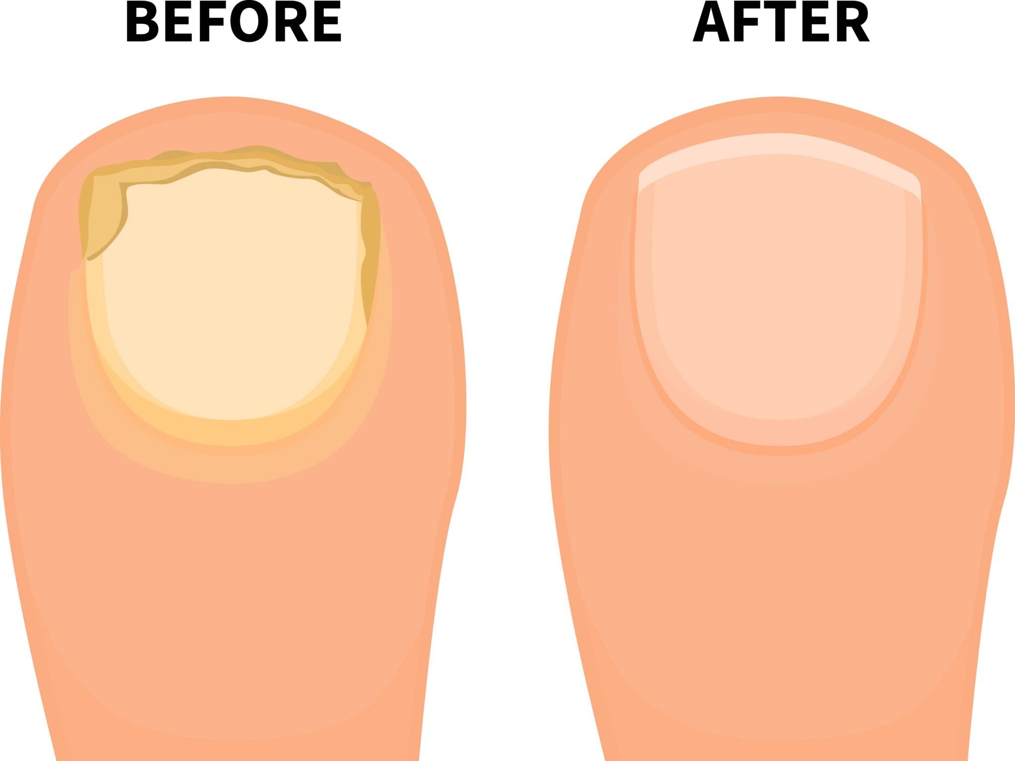 How to Treat Nail Fungus on Toes Fast? Health Tenfold