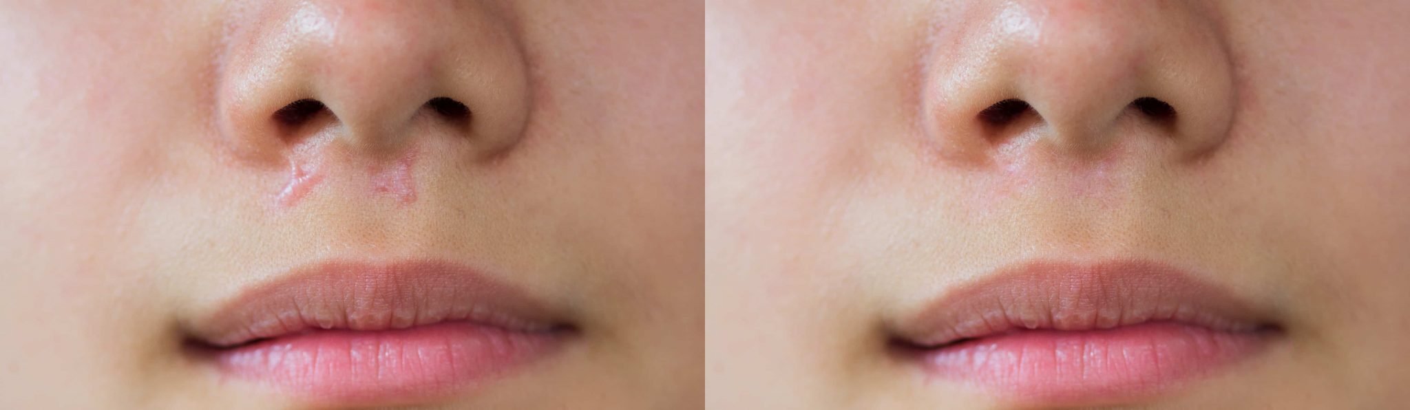 Hypertrophic Scars What Are They and How to Get Rid of Them Health