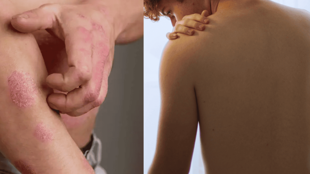 Navigating the Psoriasis Healing Stages: The Ultimate Guide