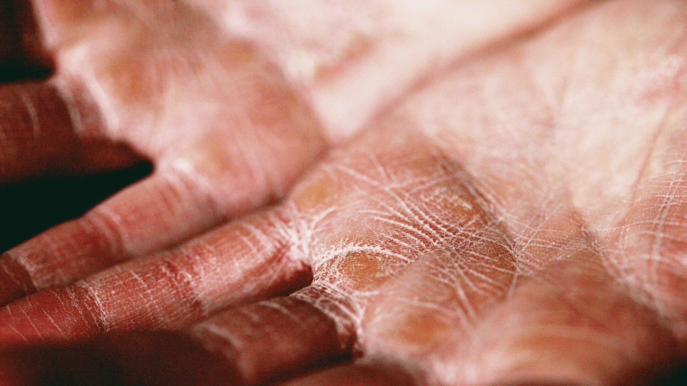 Understanding Papular Eczema Symptoms, Causes, and Treatment Options